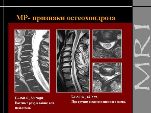 Что такое картина межпозвонкового остеохондроза Что такое картина межпозвонкового остеохондроза